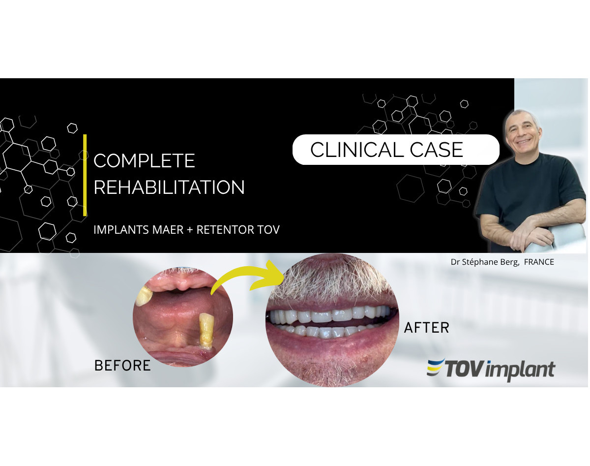 Réhabilitation complète avec implants MAER et système Retentor TOV Implant
